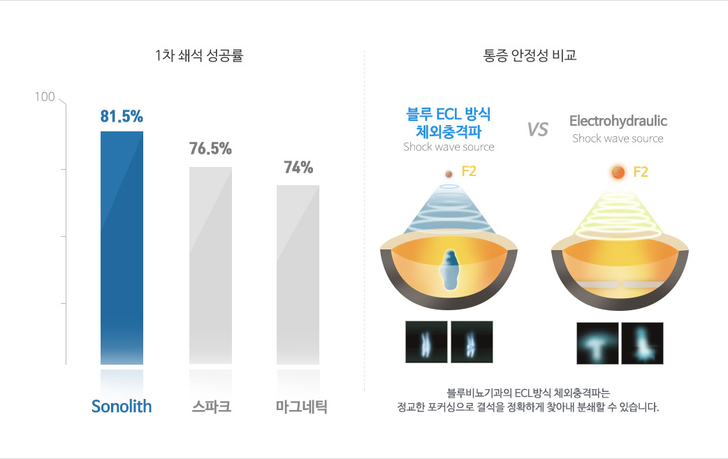 요로결석